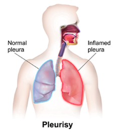 Illustration depicting inflamed pleura in the lung, causing chest pain and shortness of breath.